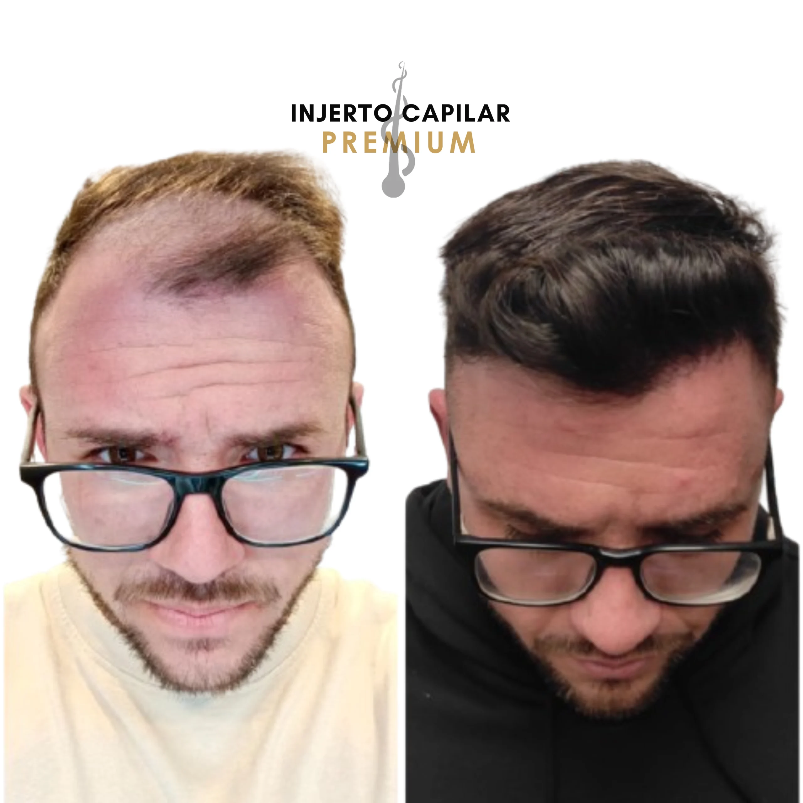 Resultado natural capilar