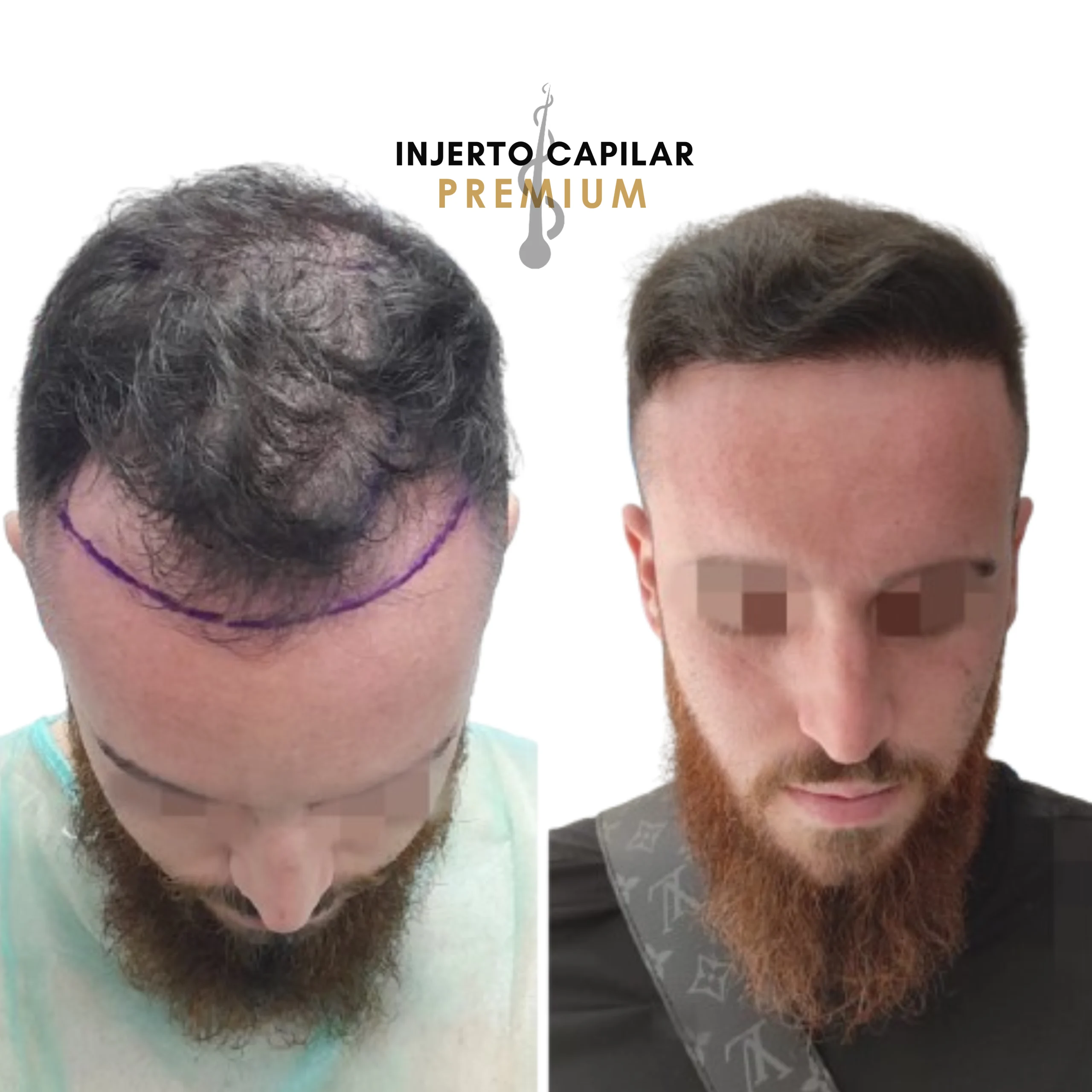 Antes y después injerto