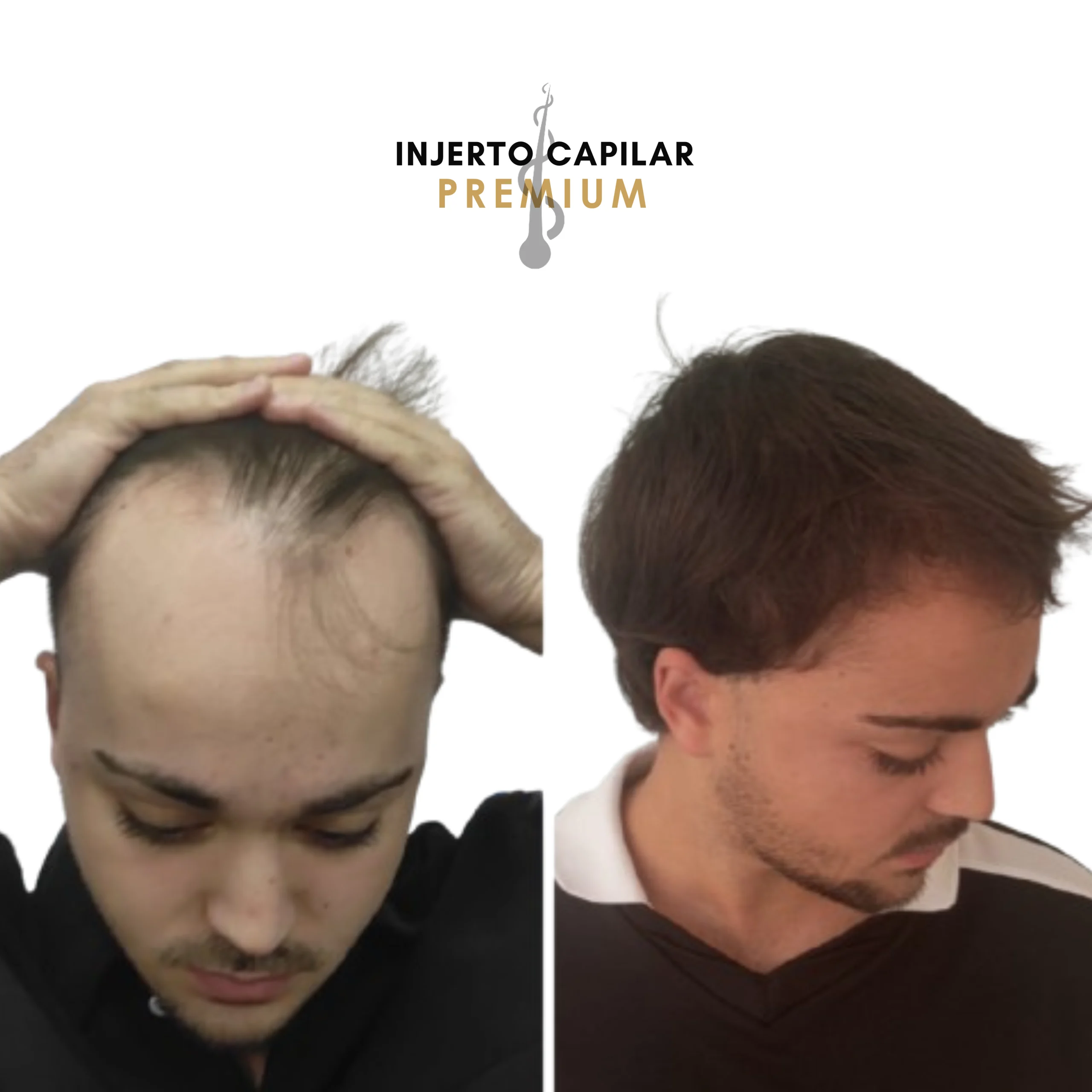 Resultado injerto capilar