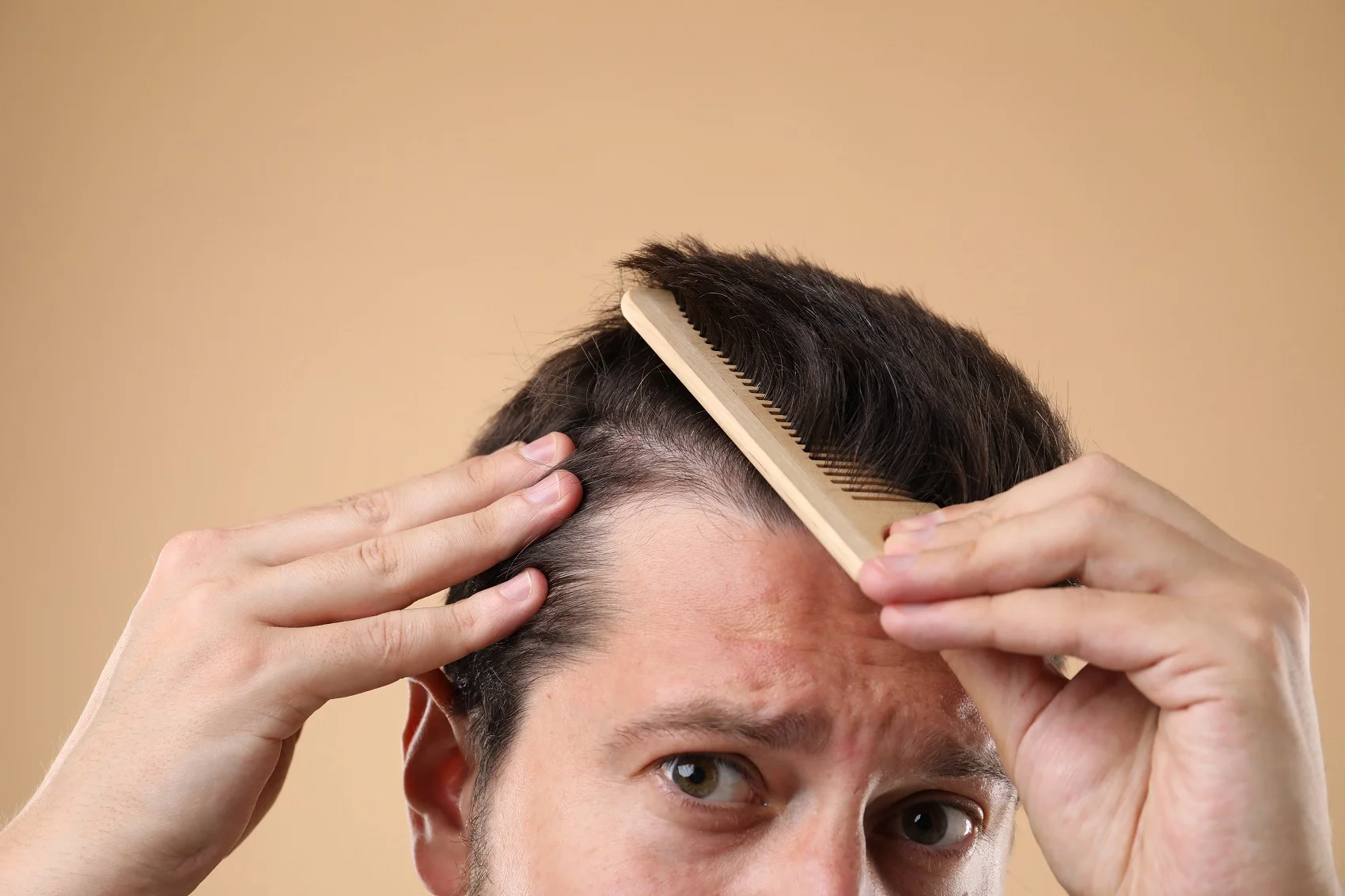 Hombre mostrando pérdida de cabello en la zona frontal antes de un trasplante capilar